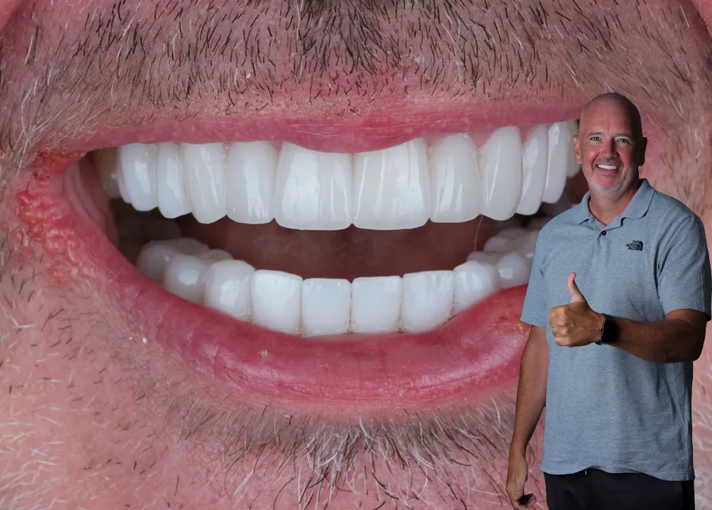 Laminate Veneers in Turkey Definition Importance Types Procedure and Advantages