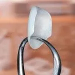Myra Dental Centre Turkey - Dental Lumineers