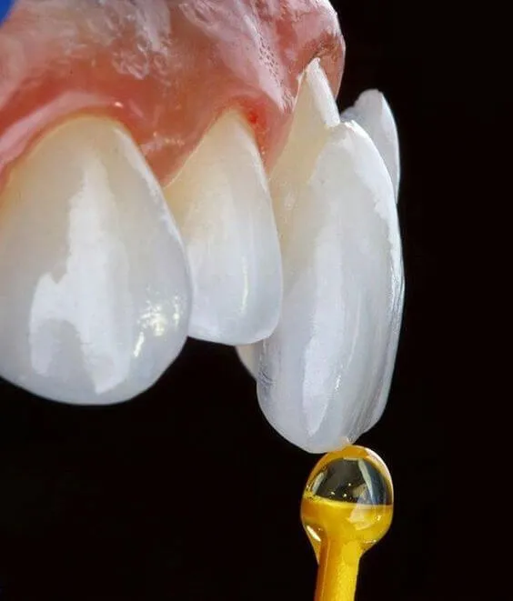 Myra Dental Centre Turkey - Dental Lumineers