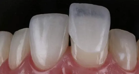 Myra Dental Centre Turkey - Dental Lumineers