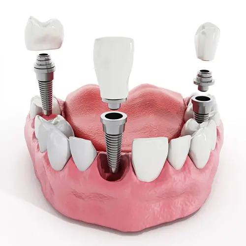 Myra Dental Centre Turkey - Dental Implants