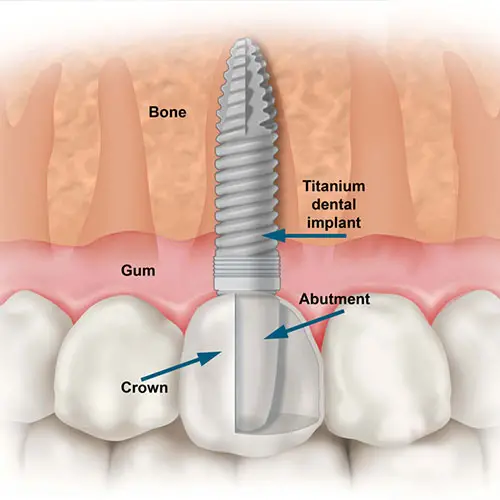 Myra Dental Centre Turkey - Dental Implants in Turkey