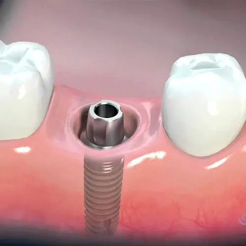 Myra Dental Centre Turkey - Dental Implants in Turkey