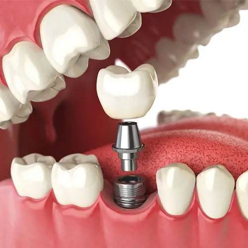 Myra Dental Centre Turkey - Dental Implants in Turkey