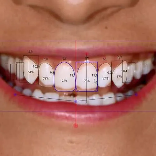 Myra Dental Centre Turkey - Digital Smile Makeover