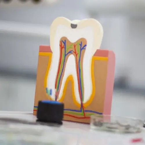 Myra Dental Centre Turkey - Dental Root Canal Operations