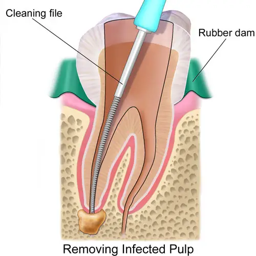 Myra Dental Centre Turkey - Dental Root Canal Operations