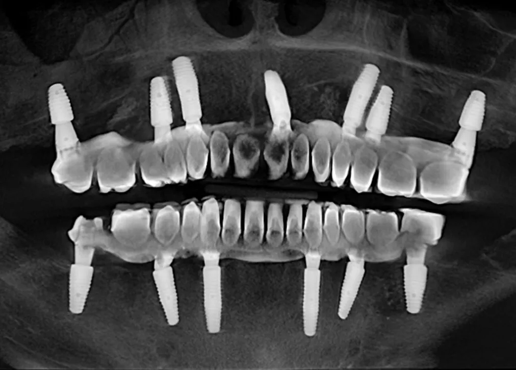 What is Sirona 3D Dental Tomography?