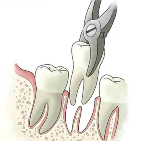 Myra Dental Centre Turkey - Tooth Extraction in Turkey