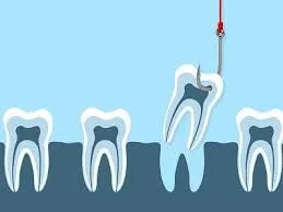 Myra Dental Centre Turkey - Tooth Extraction in Turkey