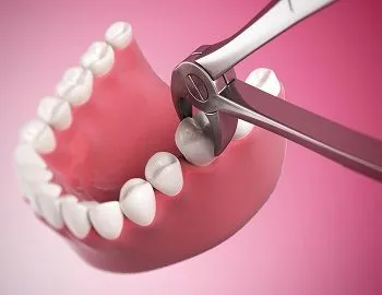 Myra Dental Centre Turkey - Tooth Extraction 