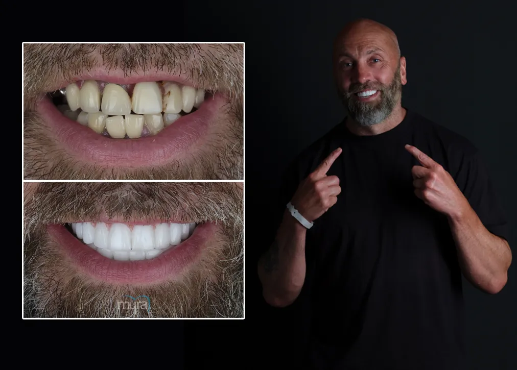 Zirconia Veneers in Turkey Types, Benefits, and More