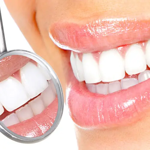 Myra Dental Centre Turkey - Teeth Whitening