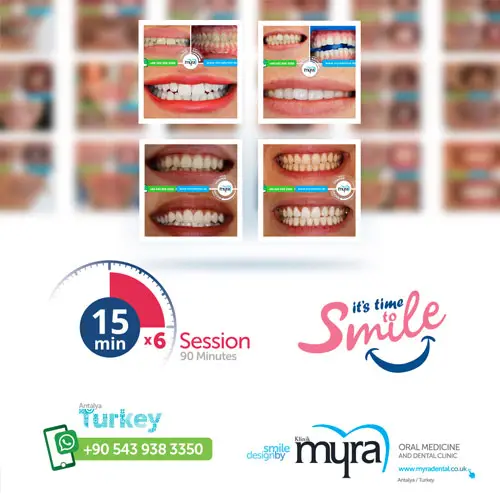 Myra Dental Centre Turkey - Dental Teeth Whitening With Zoom